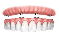 Protocolo Dentário em Campo Grande-MS na OdontoPaz CG